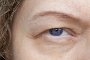 Close-up of a middle-aged female with a drooping eyelid applying eyebrow makeup, showing signs of ptosis and first wrinkles, aligned with cosmetology and facial care concepts.
