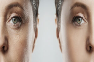 Comparison of a woman’s face before and after significant rejuvenation, showcasing results of eyelid surgery or digital retouching for a youthful appearance