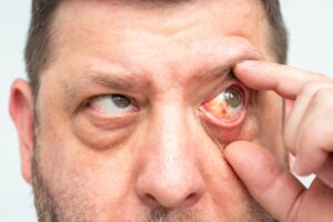 Close-up of eye with redness and visible hemorrhage, possible capillary rupture or pink eye conjunctivitis.